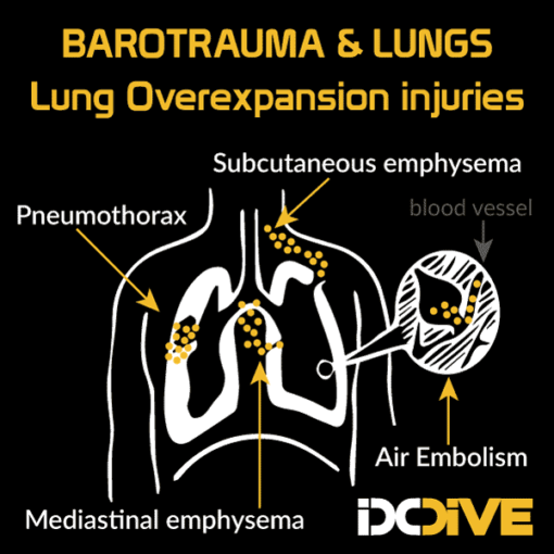 barotrauma lungs